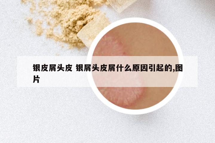 银皮屑头皮 银屑头皮屑什么原因引起的,图片