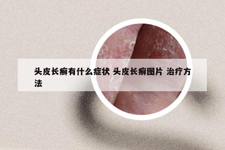 头皮长癣有什么症状 头皮长癣图片 治疗方法