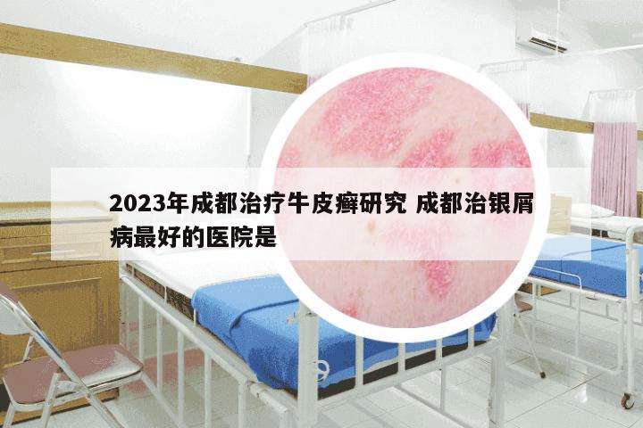 2023年成都治疗牛皮癣研究 成都治银屑病最好的医院是