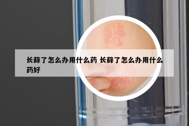 长藓了怎么办用什么药 长藓了怎么办用什么药好