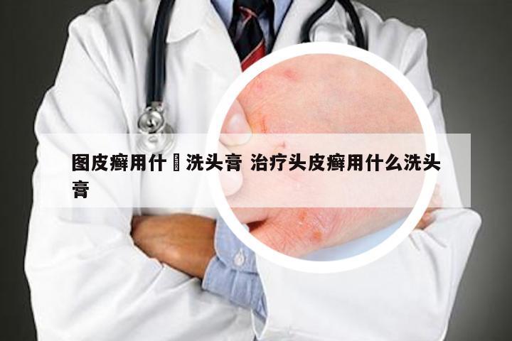 图皮癣用什麼洗头膏 治疗头皮癣用什么洗头膏