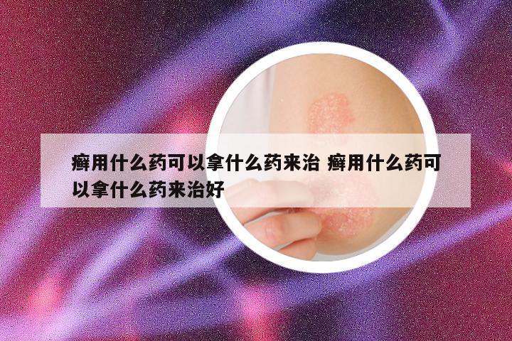 癣用什么药可以拿什么药来治 癣用什么药可以拿什么药来治好