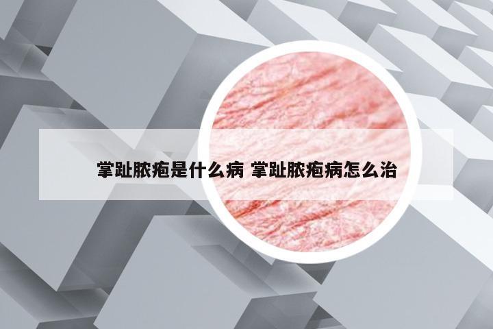 掌趾脓疱是什么病 掌趾脓疱病怎么治