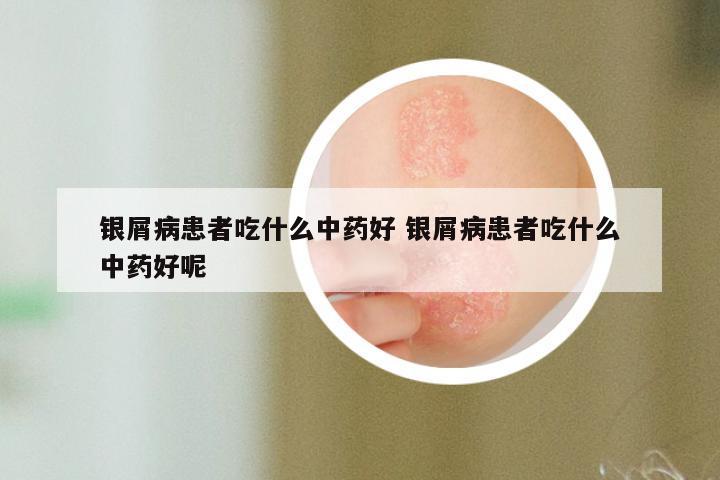 银屑病患者吃什么中药好 银屑病患者吃什么中药好呢