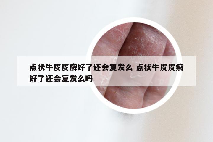 点状牛皮皮癣好了还会复发么 点状牛皮皮癣好了还会复发么吗