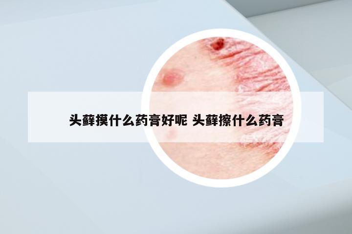 头藓摸什么药膏好呢 头藓擦什么药膏