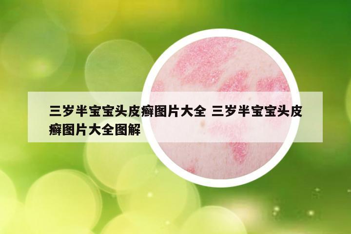 三岁半宝宝头皮癣图片大全 三岁半宝宝头皮癣图片大全图解