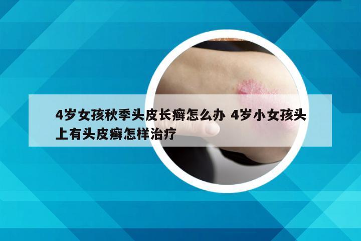 4岁女孩秋季头皮长癣怎么办 4岁小女孩头上有头皮癣怎样治疗