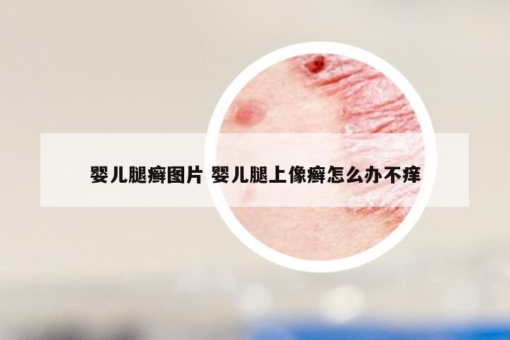 婴儿腿癣图片 婴儿腿上像癣怎么办不痒