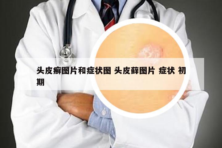 头皮癣图片和症状图 头皮藓图片 症状 初期