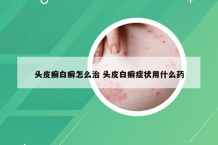 头皮癣白癣怎么治 头皮白癣症状用什么药