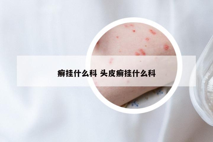 癣挂什么科 头皮癣挂什么科