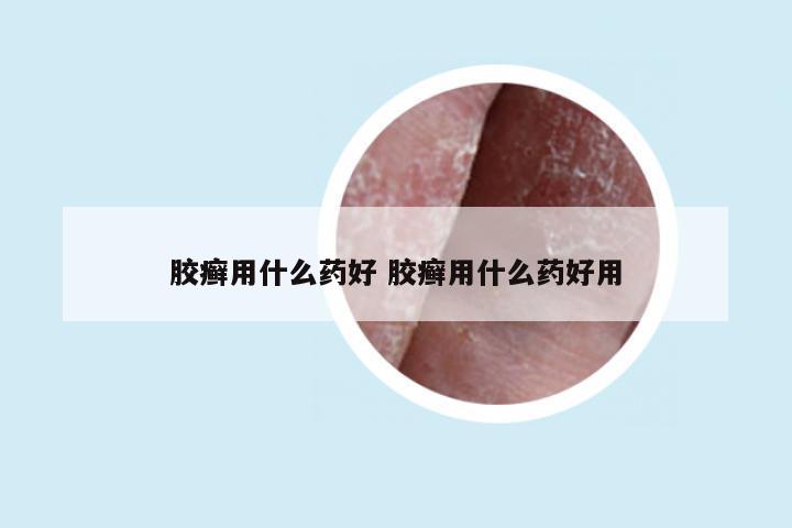 胶癣用什么药好 胶癣用什么药好用