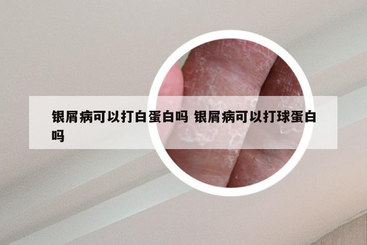 银屑病可以打白蛋白吗 银屑病可以打球蛋白吗