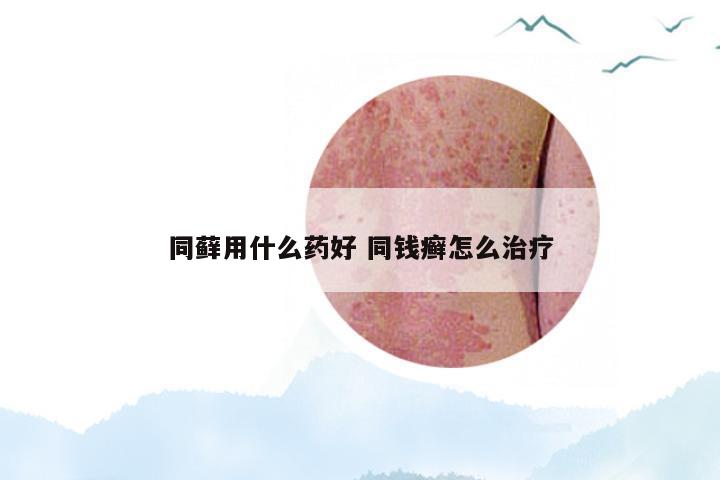 同藓用什么药好 同钱癣怎么治疗