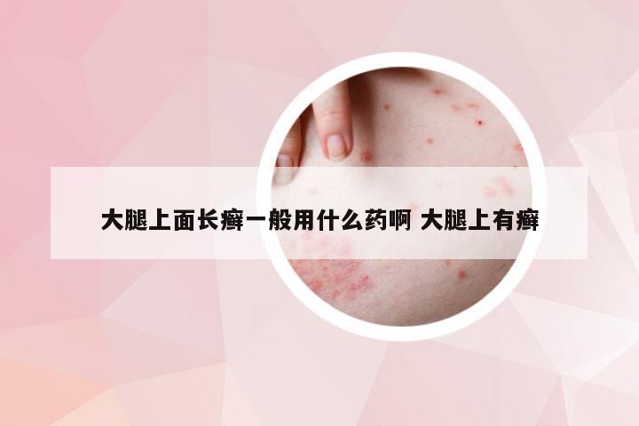 大腿上面长癣一般用什么药啊 大腿上有癣