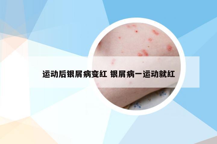 运动后银屑病变红 银屑病一运动就红