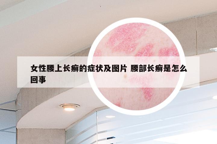 女性腰上长癣的症状及图片 腰部长癣是怎么回事