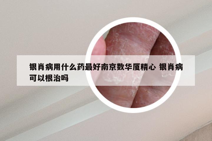 银肖病用什么药最好南京数华厦精心 银肖病可以根治吗