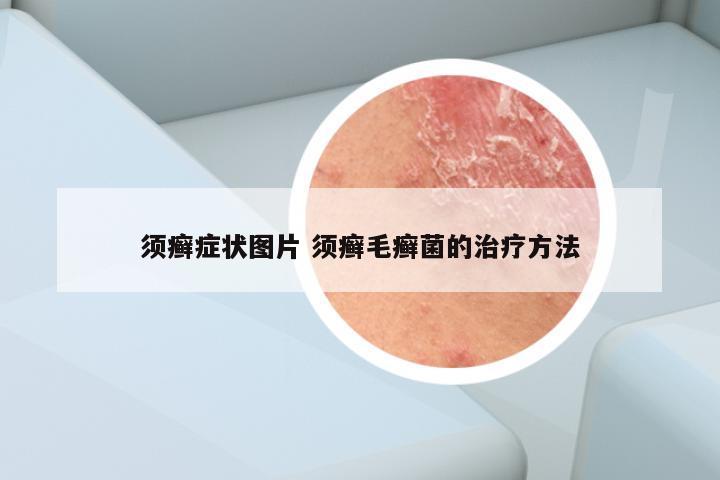 须癣症状图片 须癣毛癣菌的治疗方法