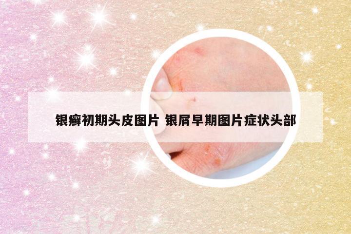 银癣初期头皮图片 银屑早期图片症状头部