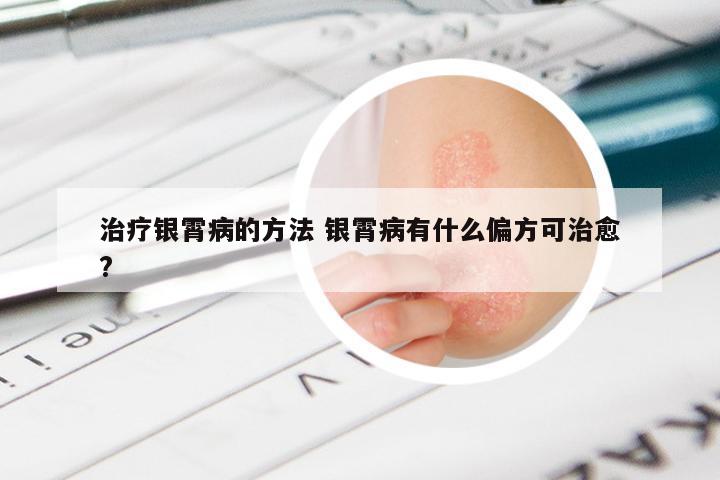 治疗银霄病的方法 银霄病有什么偏方可治愈?