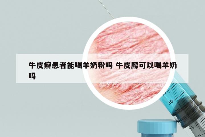 牛皮癣患者能喝羊奶粉吗 牛皮廨可以喝羊奶吗