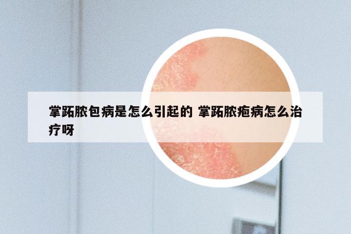 掌跖脓包病是怎么引起的 掌跖脓疱病怎么治疗呀