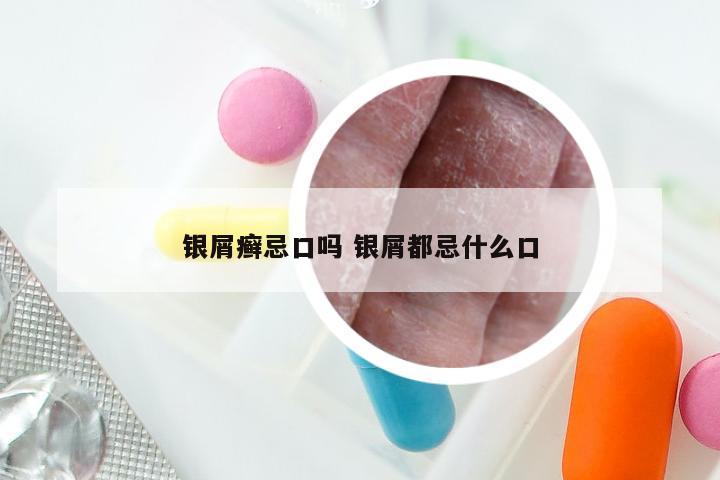 银屑癣忌口吗 银屑都忌什么口