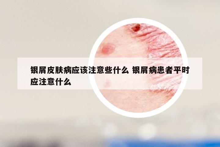 银屑皮肤病应该注意些什么 银屑病患者平时应注意什么
