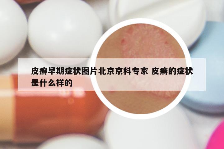 皮癣早期症状图片北京京科专家 皮癣的症状是什么样的