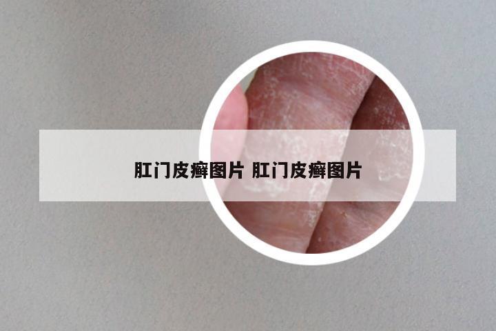 肛门皮癣图片 肛门皮癣图片