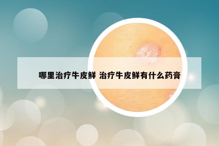 哪里治疗牛皮鲜 治疗牛皮鲜有什么药膏