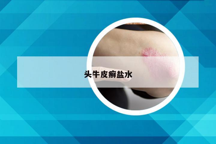 头牛皮癣盐水