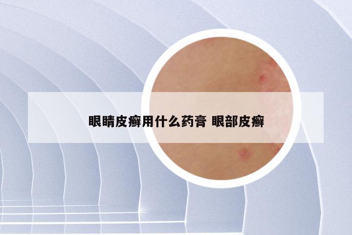 眼睛皮癣用什么药膏 眼部皮癣