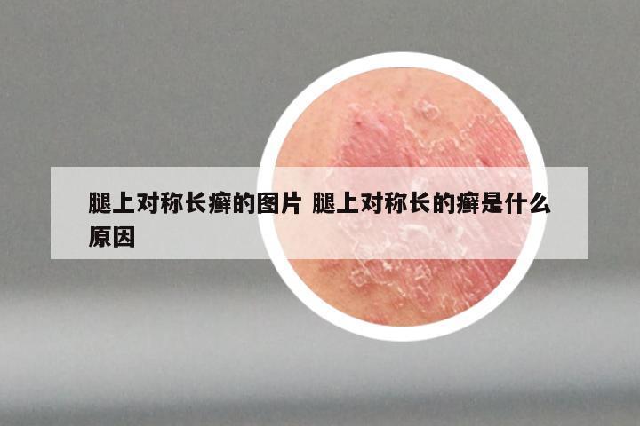 腿上对称长癣的图片 腿上对称长的癣是什么原因