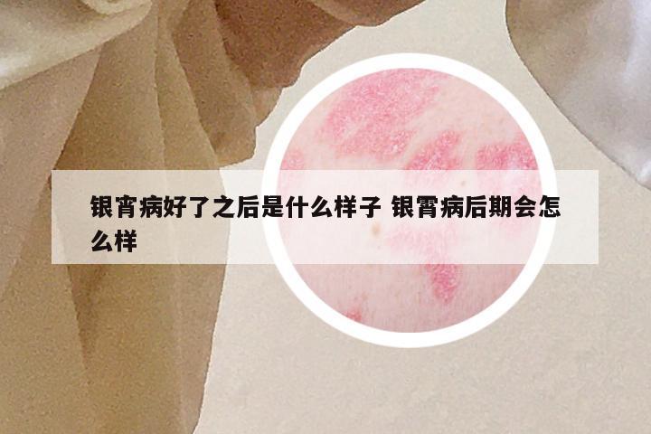 银宵病好了之后是什么样子 银霄病后期会怎么样