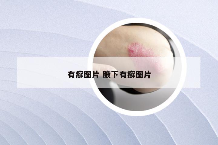 有癣图片 腋下有癣图片