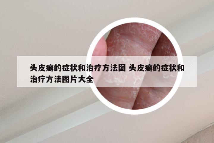 头皮癣的症状和治疗方法图 头皮癣的症状和治疗方法图片大全