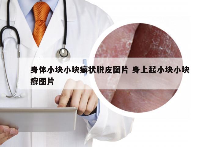 身体小块小块癣状脱皮图片 身上起小块小块癣图片