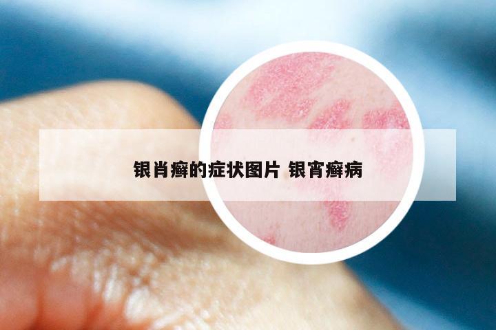 银肖癣的症状图片 银宵癣病