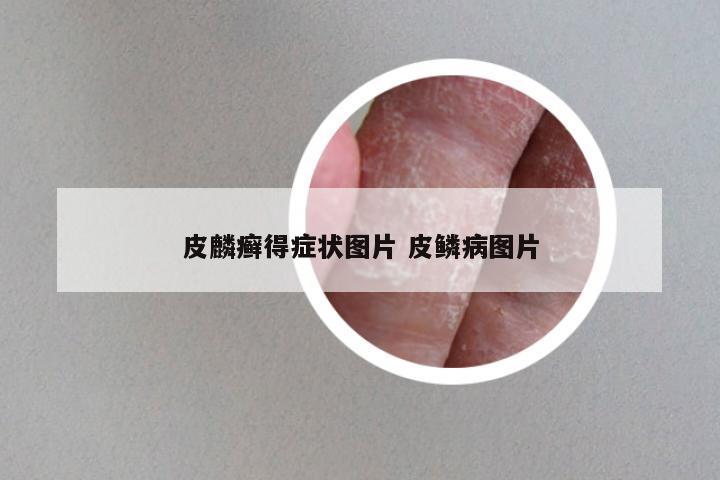 皮麟癣得症状图片 皮鳞病图片