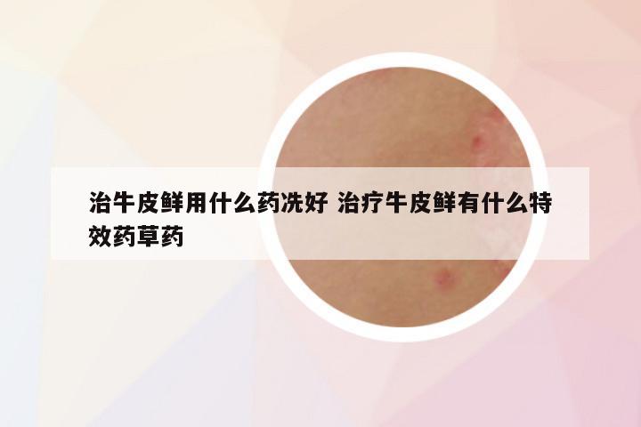 治牛皮鲜用什么药冼好 治疗牛皮鲜有什么特效药草药