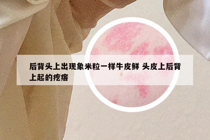后背头上出现象米粒一样牛皮鲜 头皮上后背上起的疙瘩