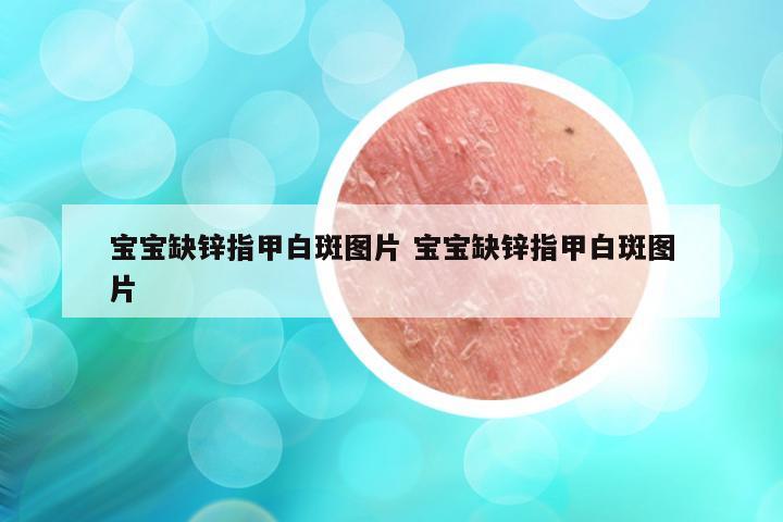 宝宝缺锌指甲白斑图片 宝宝缺锌指甲白斑图片