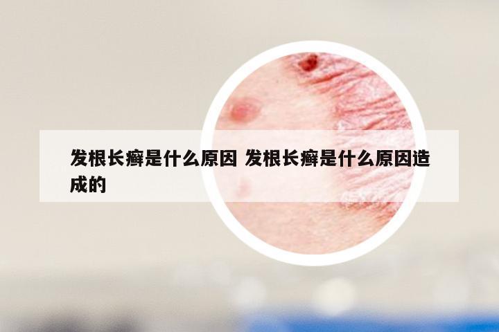 发根长癣是什么原因 发根长癣是什么原因造成的