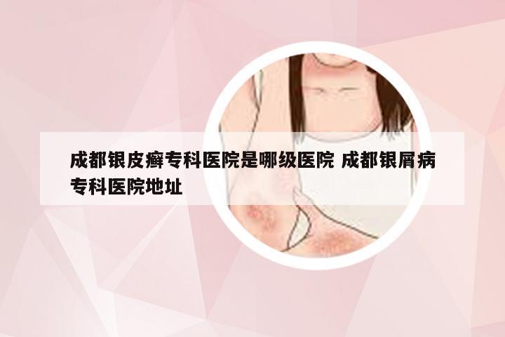 成都银皮癣专科医院是哪级医院 成都银屑病专科医院地址