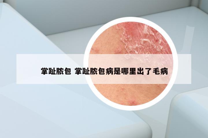 掌趾脓包 掌趾脓包病是哪里出了毛病
