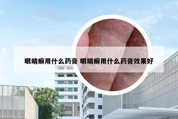 眼睛癣用什么药膏 眼睛癣用什么药膏效果好