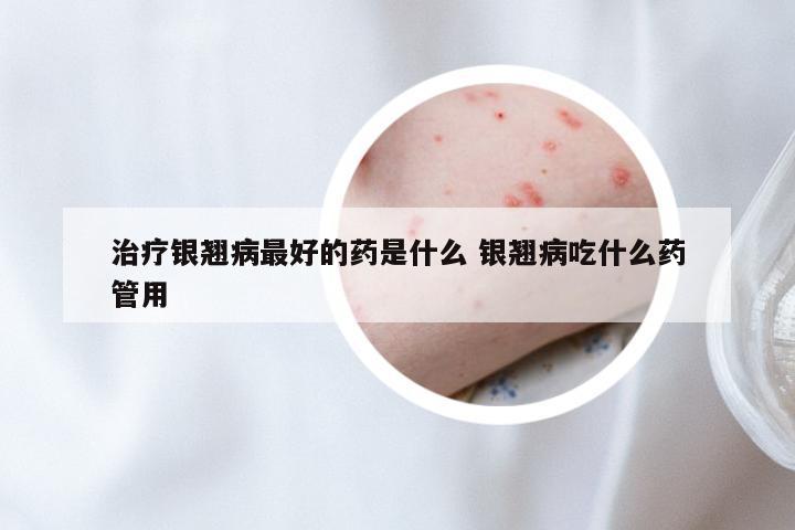 治疗银翘病最好的药是什么 银翘病吃什么药管用